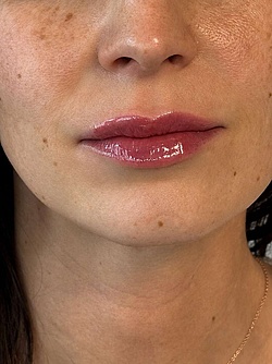 Lippenästhetik - 13