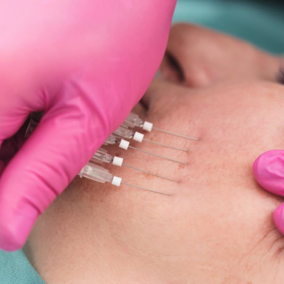 Behandlung mit PDO Faden