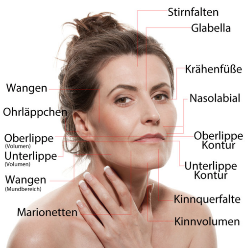 Zonen im Gesicht, wo eine Unterspritzung mit Hyaluronsäure erfolgen kann