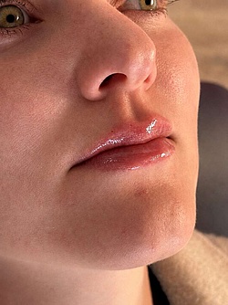 Lippenästhetik - 16