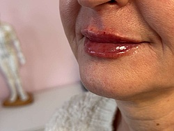 Lippenästhetik - 9