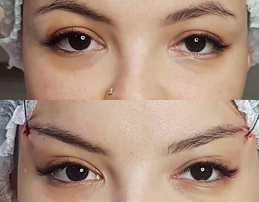 Vorher Nachher Cat Eyes / Fox Eyes / Bella Eyes mit Fadenlifting