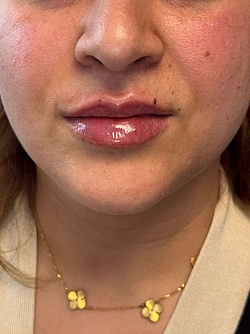 Lippenästhetik - 11