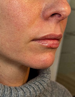Lippenästhetik - 12
