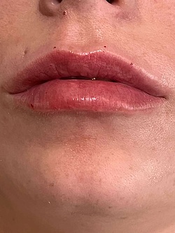Lippenästhetik - 3