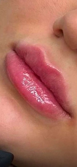 Lippenästhetik - 4