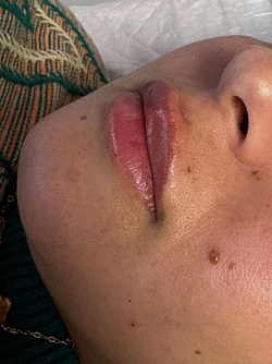 Lippenästhetik - 5
