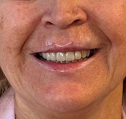 Lippenästhetik - 2