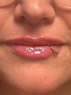 Lippenästhetik - 8