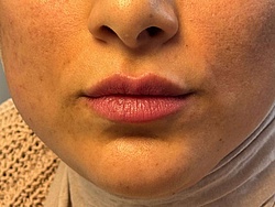 Lippenästhetik - 6