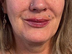 Lippenästhetik - 10