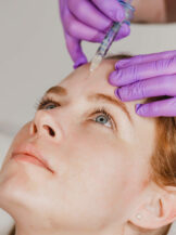 Faltenunterspritzung mit Hyaluronsäure